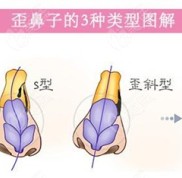 這家能告知南寧做歪鼻手術(shù)矯正要多少錢