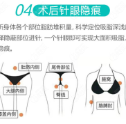 合肥藝星吸脂哪個醫(yī)生好