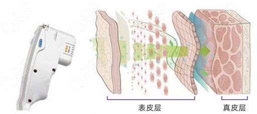 7d聚拉提和歐洲之星fotona4d有啥區(qū)別