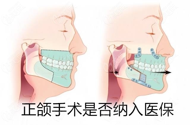 正颌手术是否纳入医保