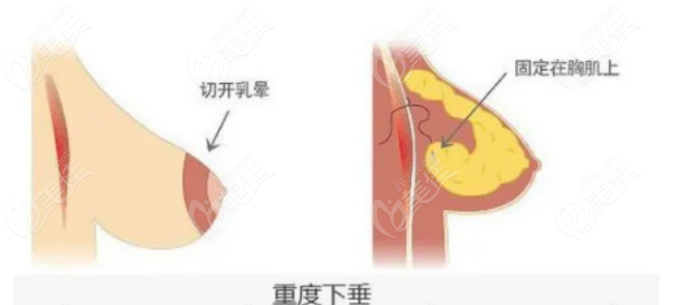 胸挺大的但下垂