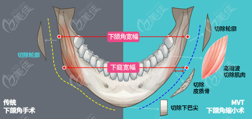 韓國下頜角磨骨醫(yī)院排名前三