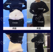 濟南海峽吸脂手術怎么樣