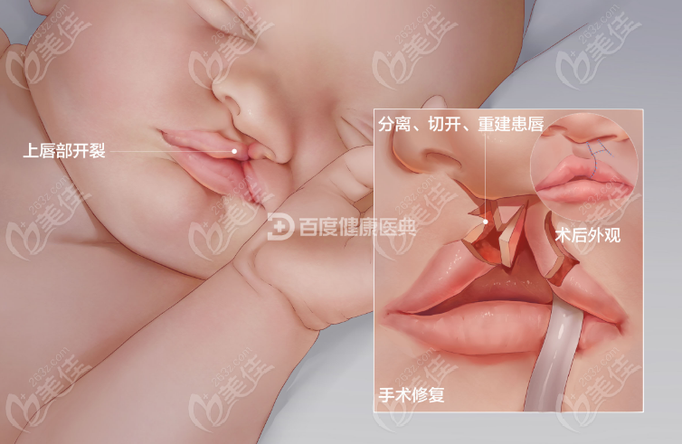 廣州唇腭裂醫(yī)生排名2022