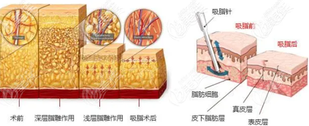 魔力塑吸脂是什么