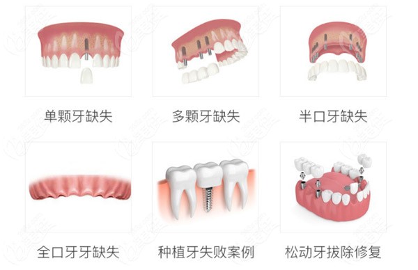 目前三种安假牙的方式哪种好