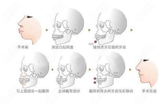 正颌手术和正畸的区别是什么