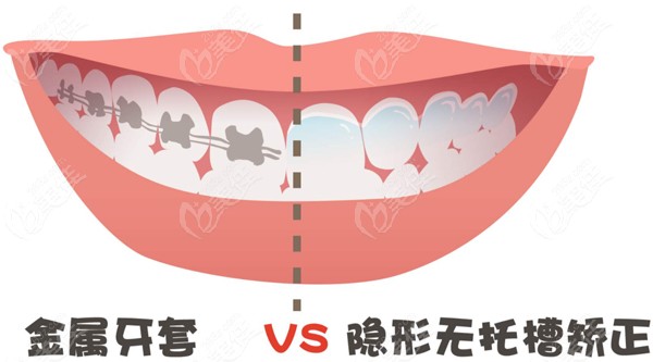 在杭州做牙齿矫正大概要花多少钱