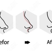 成都鼻修復(fù)哪個醫(yī)院醫(yī)生好