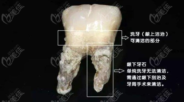 牙周炎刮治費(fèi)用是多少