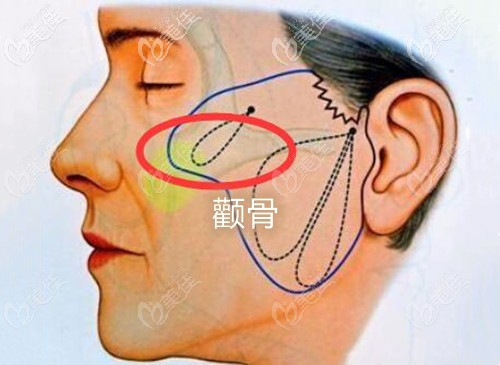 做拉皮手術后顴骨變的又高又寬還能恢復嗎