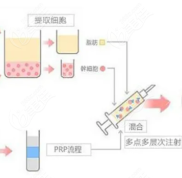 保定悅美整形叢相文醫(yī)生做自體脂肪豐胸怎么樣