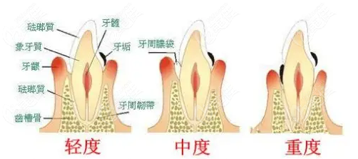 牙周炎一定要全口刮治嗎