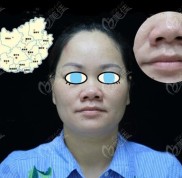 廣西鼻想通過(guò)肋軟骨隆鼻改善選南寧愛(ài)思特和南寧華美哪個(gè)好