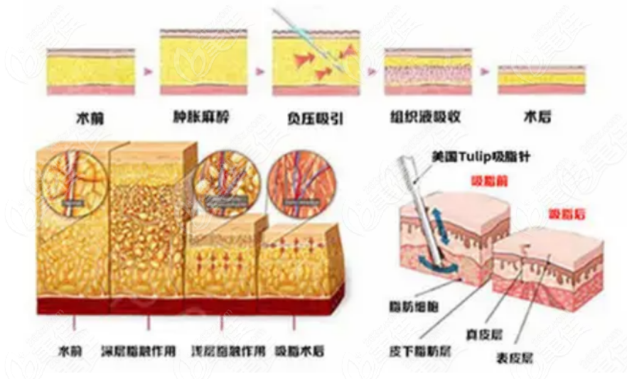 聚能振波吸脂手術(shù)多少錢