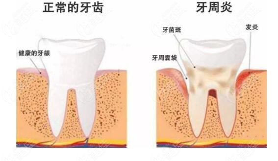 別說牙周炎治療費(fèi)用5000貴嗎