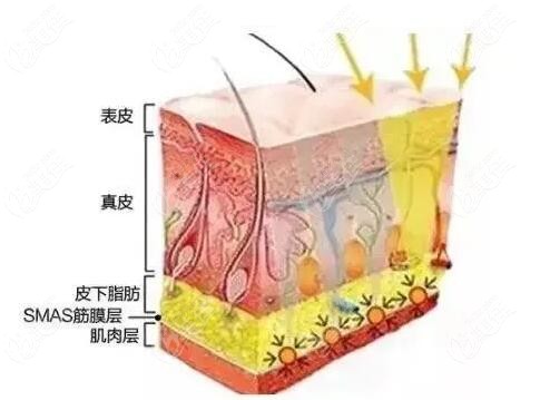 除皺抗衰選賽諾秀5d膠原光和歐洲之星fotona4d哪個(gè)好