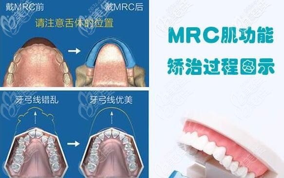 mrc矯正器適合多大兒童矯正