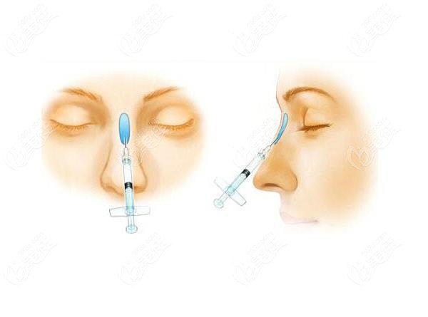 贵阳利美康可以做失败的鼻整形修复手术
