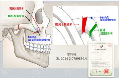 上海顴骨內(nèi)推哪個(gè)醫(yī)生好呢