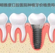 昆明市官渡區(qū)雅度口腔種植牙收費(fèi)高嗎