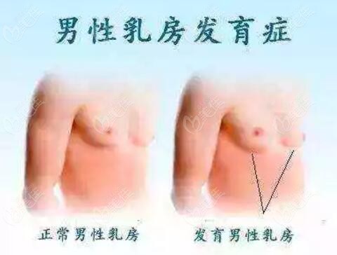 男性乳房肥大做抽脂手術(shù)會反彈嗎