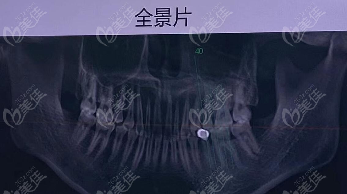 正畸剩下24顆牙會(huì)讓臉?biāo)輪? /></span></p><p style=