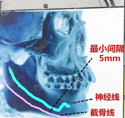 下頜角截骨留角不留角對(duì)比圖讓你一目了然什么情況下留角什么情況不留角