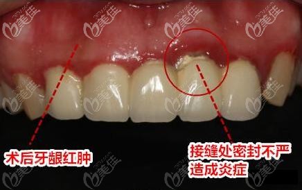 聽說全瓷牙會壓迫牙齦腫痛