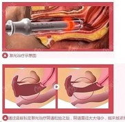 洛陽做私密整形手術多少錢