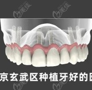 南京玄武區(qū)種植牙哪家醫(yī)院好