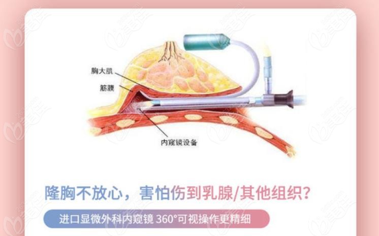 合肥维多利亚何贤清做维密丰胸技术挺好