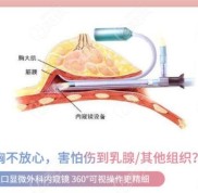 合肥維多利亞何賢清做維密豐胸技術(shù)挺好