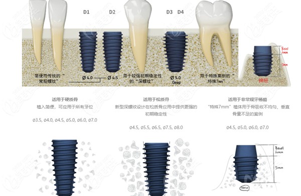 美格真植體分為哪幾種型號(hào)