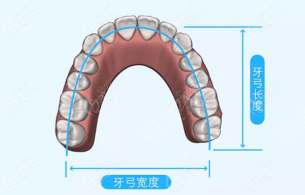 话说牙弓窄一定要扩弓么