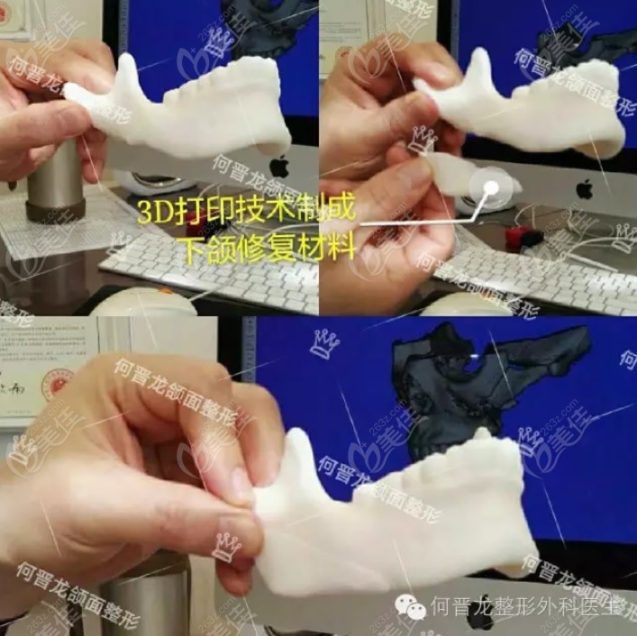 上海何晋龙医生3D打印修复下颌角和颧骨颧弓的收费标准