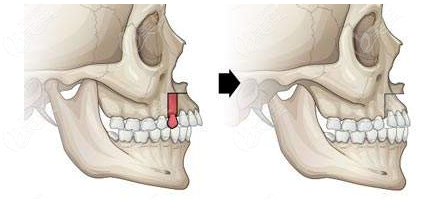 下巴截骨前移多久可以修復(fù)呢