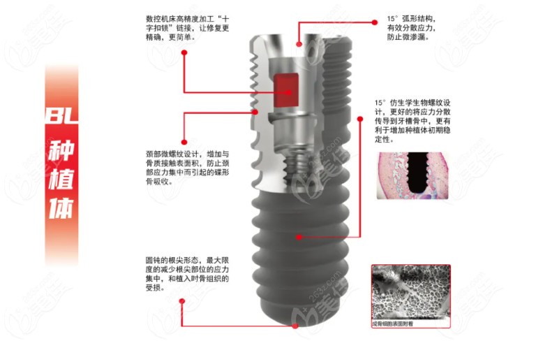 晓得了创英种植体多少钱一颗