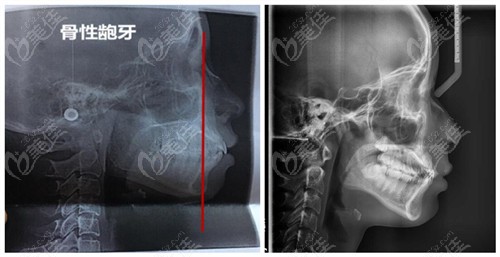 那些很后悔做骨性齙牙正畸的朋友來看下我骨性齙牙矯正前后外貌變化有多大