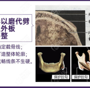 重慶華美做下頜角磨骨挺可靠的