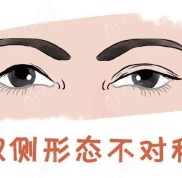 鄭州做雙眼皮修復(fù)多少錢