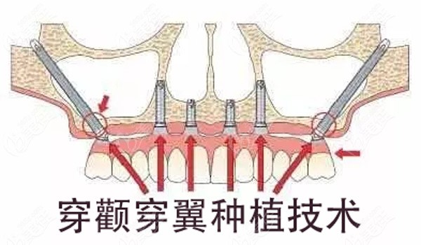 目前三种安假牙的方式哪种好