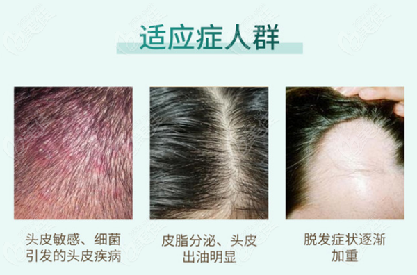 北京新生植发的七彩虹头皮护理多少钱