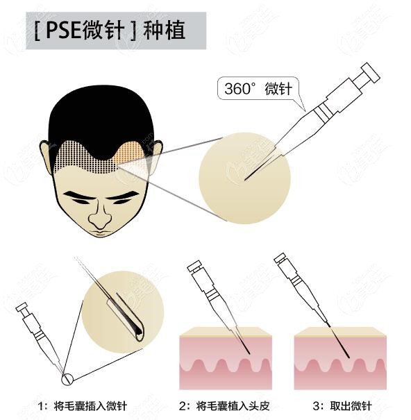 在广州番禺采用微针技术植发4000个单位大概多少钱跟采用什么技术有关