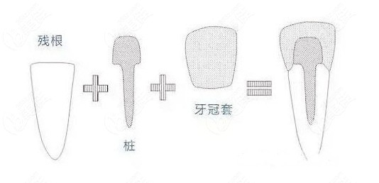 牙齒打樁做牙套一般能用多久