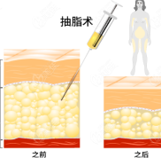 銅仁哪家醫(yī)院抽脂好呀