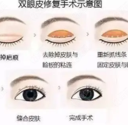 西安哪個(gè)醫(yī)院修復(fù)雙眼皮技術(shù)好