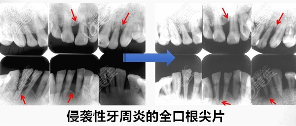 患重度侵襲性牙周炎做全口種植義齒會導致種植牙失敗嗎