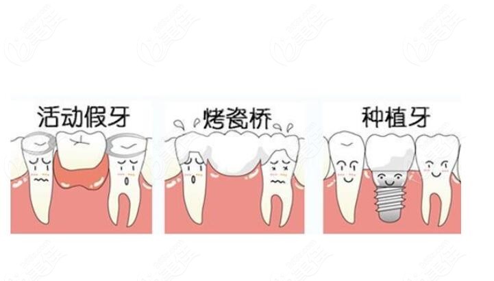 鑲牙過程分為幾個(gè)步驟