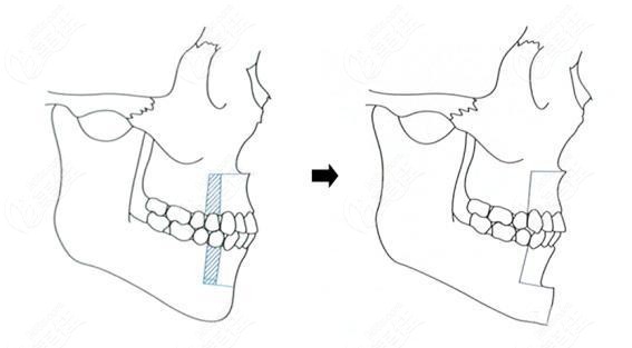 下巴后縮做假體墊下巴好還是截骨前移好呢